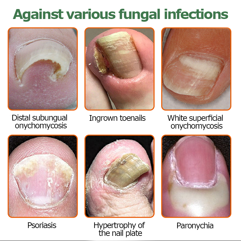 👩‍⚕️Furzero™ Bee Venom Nail Fungus Treatment Solution(For All Kinds Of Nail Diseases✅For Healthier Nail Growth)