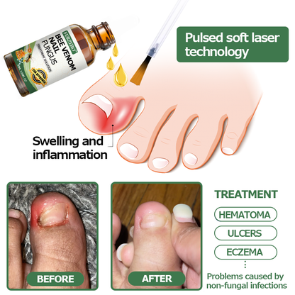 👩‍⚕️Furzero™ Bee Venom Nail Fungus Treatment Solution(For All Kinds Of Nail Diseases✅For Healthier Nail Growth)