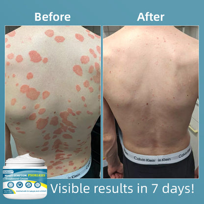 Ourlyard™ Multi-Symptom Psoriasis Treatment Cream（👨‍⚕Doctor's Recommendation）