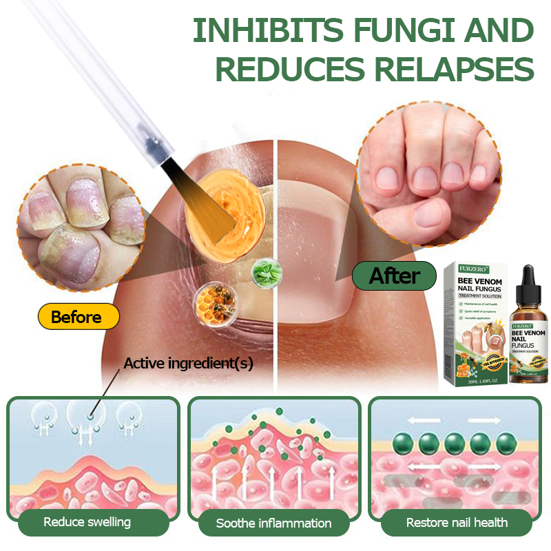 👩‍⚕️Furzero™ Bee Venom Nail Fungus Treatment Solution(For All Kinds Of Nail Diseases✅For Healthier Nail Growth)