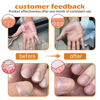 Furzero™ PsoriaHeal Bee Venom Psoriasis Treatment Spray(Suitable for all skin conditions)