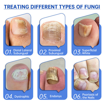 👍Furzero™ PureNail Fungus Laser Therapy Device