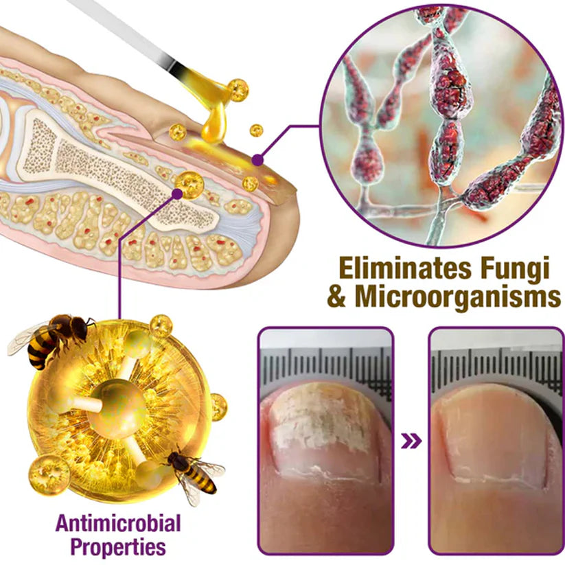 🐝flysmus™ Fungus-Fres Bee Venom Nail Treatment Serum