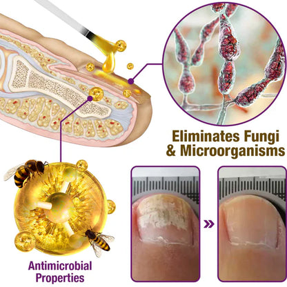 🐝flysmus™ Fungus-Fres Bee Venom Nail Treatment Serum