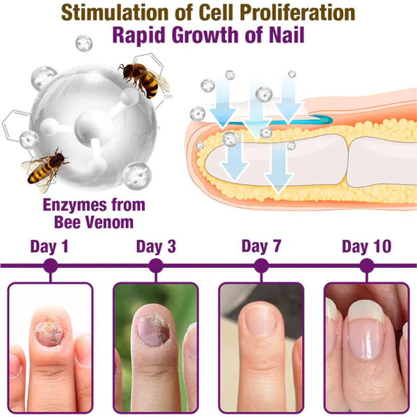 🐝flysmus™ Fungus-Fres Bee Venom Nail Treatment Serum