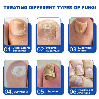 Furzero™ Fungal Nail Treatment Laser Device