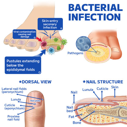 Furzero™ Fungal Nail Treatment Laser Device