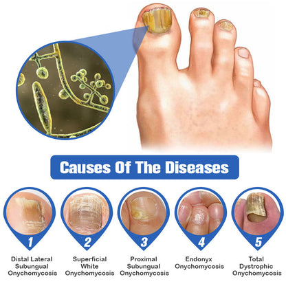 Furzero™ Nail Fungus Laser Therapy Device-