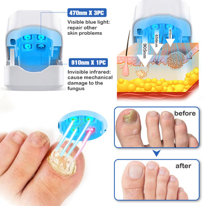 Furzero™ Nail Fungus Laser Therapy Device-