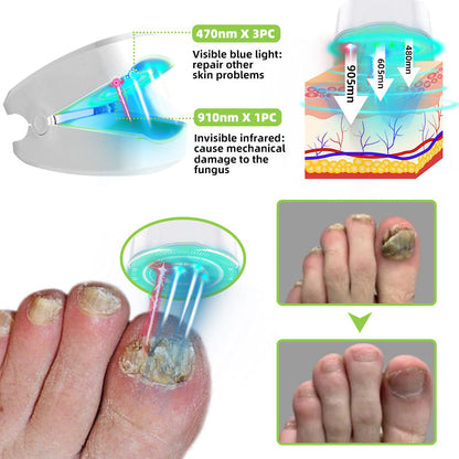 Furzero™ Nail Fungus Laser Therapy Device Max
