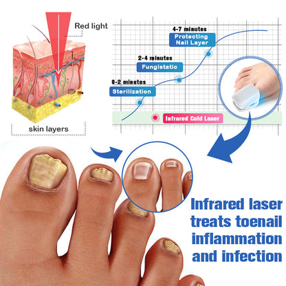 Furzero™ Nail Fungus Laser Therapy Device-