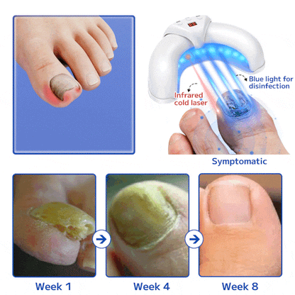 Furzero™ Fungal Nail Treatment Laser Device
